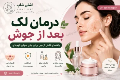 درمان لک بعد از جوش؛ راهنمای کامل از بین بردن جای جوش قهوه‌ای
